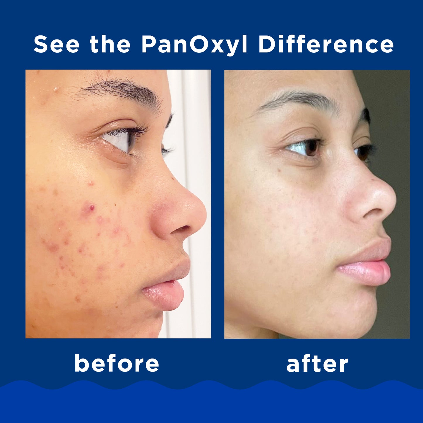 PanOxyl, Acne Foaming Wash, For Face & Body, Maximum Strength, 5.5 oz (156 g)